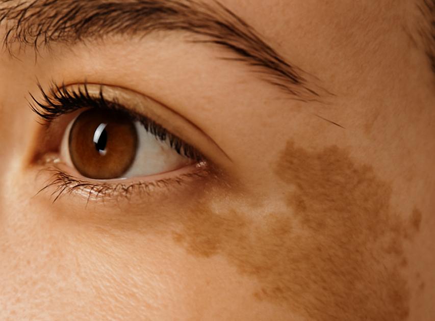Candidates for Skin Whitening Treatment | Dr. Haror's Wellness Candidates for Skin Whitening Treatment | Dr. Haror's Wellness