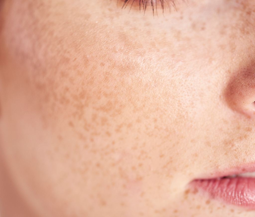 Common Myths About Facial Pigmentation | Dr. Haror's Wellness Common Myths About Facial Pigmentation | Dr. Haror's Wellness